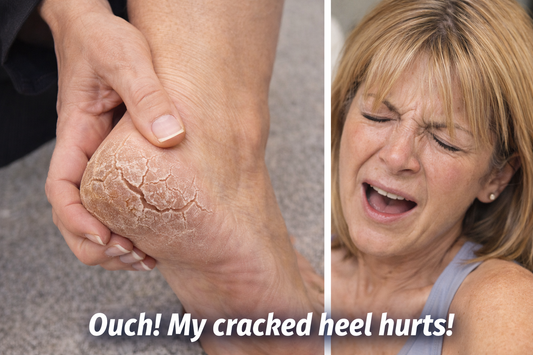 Every Step Hurts: The Secret to Healing Your Cracked Heels Finally Revealed
